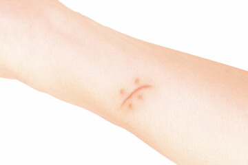 Scar of suture in a white skin femenine arm