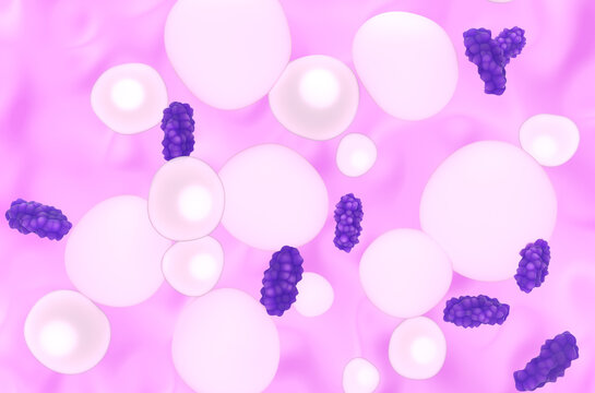 Liposarcoma - isometric view 3d illustration