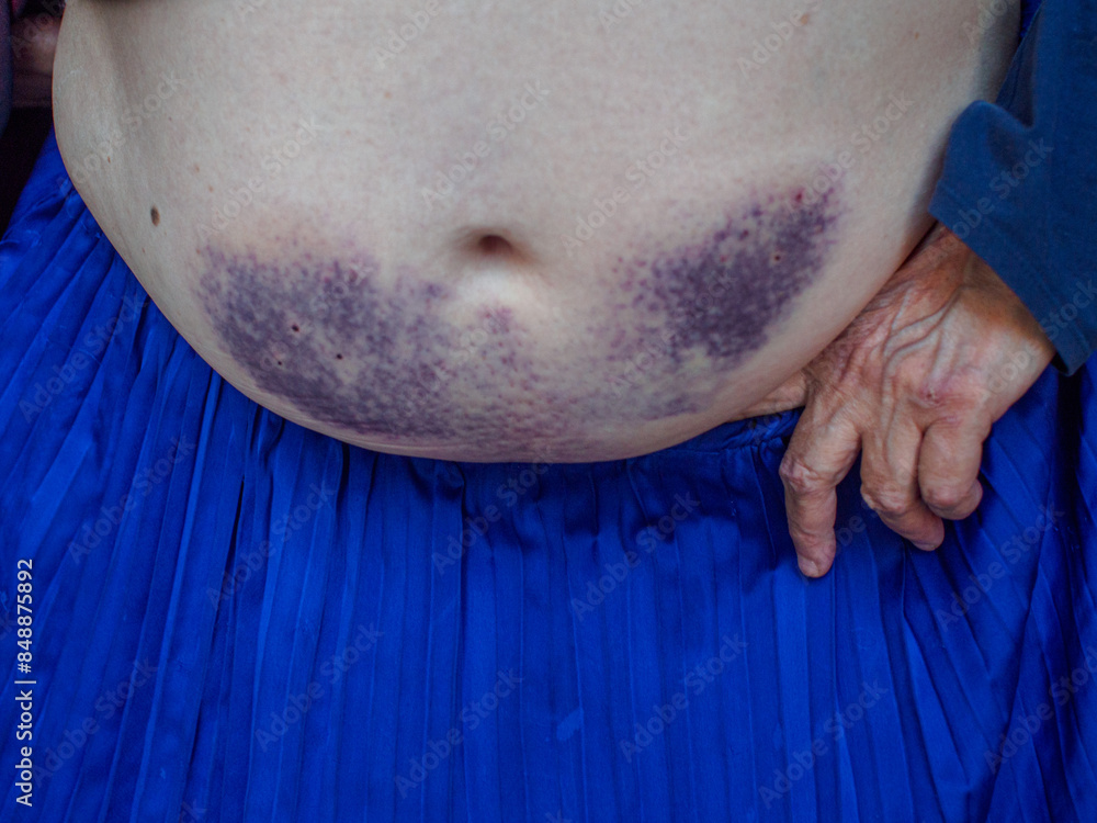 Wall mural senior woman showing large purple bruises on stomach due to heparin anticoagulant treatment