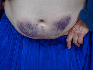 Senior woman showing large purple bruises on stomach due to heparin anticoagulant treatment