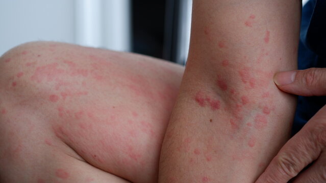 Close up image of skin texture suffering severe urticaria or hives or kaligata on a man's thighs and arm. Allergy symptoms.