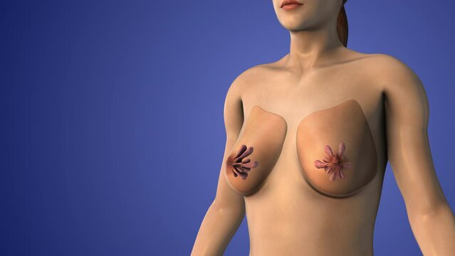 Breast lift or mastopexy surgery