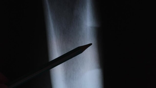 Medical treatment concept. Diagnosis of the disease humans bones. Cancer danger.