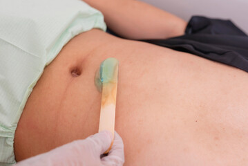 Applying Ultrasound Conductive Gel on abdomen for radiofrequency, cavitation, microcurrent, ultrasound and other treatments.
