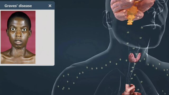 Common Thyroid problems and diseases