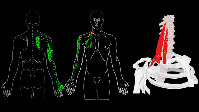 Scalene muscles illustration. Muscles, Trigger Points and Referred Trigger Pain
