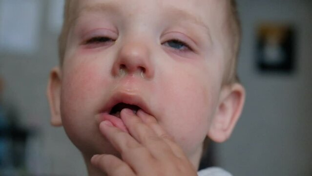 Red swollen eyes from conjunctivitis child, ill allergic eyes in babies. Close-up of a baby with conjunctivitis