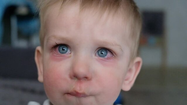 Red swollen eyes from conjunctivitis child, ill allergic eyes in babies. Close-up of a baby with conjunctivitis
