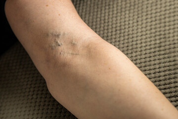 Caucasian woman have a varicose on inner side of arm