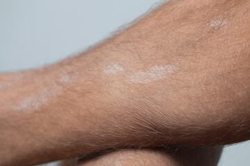 Large plaque parapsoriasis on caucasian man legs