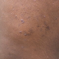 Eczema on brown skin, atopic dermatitis and prurigo nodularis on brown skin leg, eczema breakout on...
