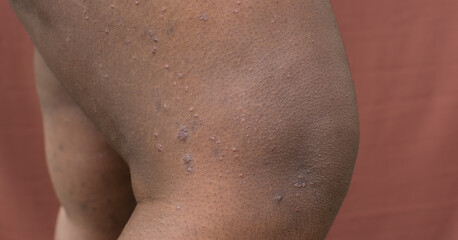 Eczema on brown skin, atopic dermatitis and prurigo nodularis on brown skin leg, eczema breakout on...