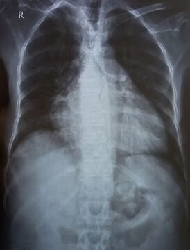 Chest x-ray image demonstrated heart, lungs, ribs, bones and muscles. Xray shown cardiomegaly in congestive heart failure.