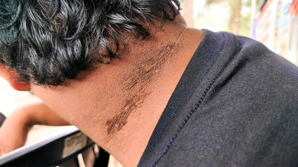 Black stains on the neck. sunburned neck. Acanthosis nigricans. 