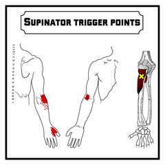 Supinator trigger points vector diagram