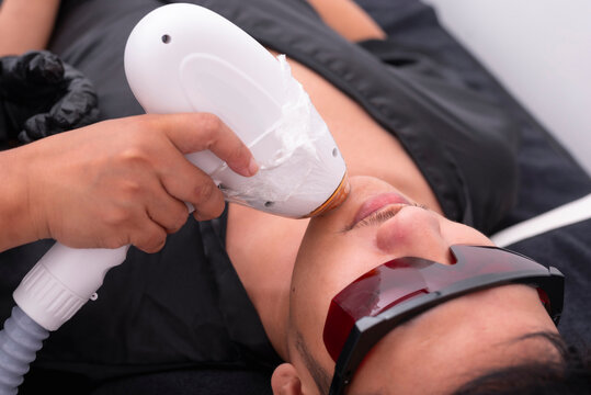 Diode ICE laser hair removal procedure at an aesthetic clinic. Removing facial hair in the beard area from a male asian patient.
