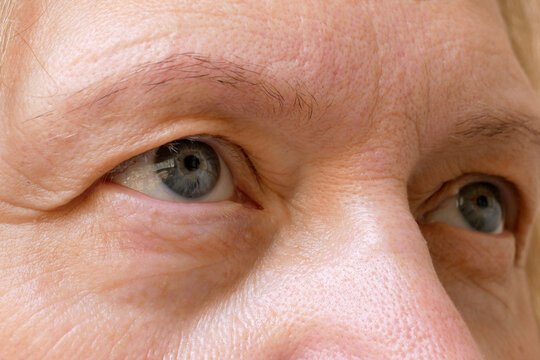middle aged female's face with drooping eyelid eyes. Ptosis is a drooping of the upper eyelid, lazy eye, first wrinkles