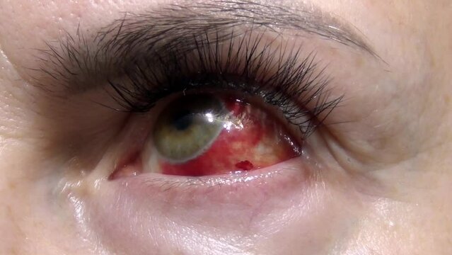 close-up of a woman's eye, heavily bloodshot, sore. Blepharitis, conjunctivitis
