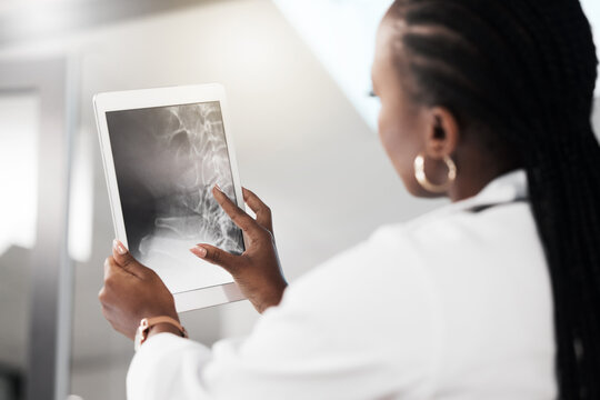 Doctor, x ray and back in hospital with tablet, examining and digital healthcare or spine anatomy with medical professional. Fracture, skeleton review and assessment for patient, radiology and woman