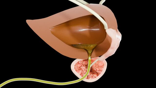 Benign prostatic, Enlargement and inflammation of the prostate, hypertrophy, hyperplasia (BPH), male reproductive system, bladder anatomy, urology, enlarged prostate gland, Prostatitis, 3d render