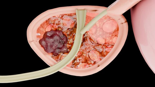 Prostate cancer stages. ancerous cells, malignant tumor compresses urethra. Pathological disruption, genital reproductive system anatomy, bladder Oncological or Urological Disease, bph, 3d render