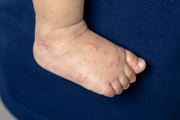 Close-up of a child's feet infected with hand-foot-mouth disease or HFMD originating from...