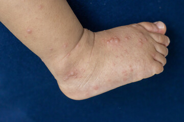 Close-up of a child's feet infected with hand-foot-mouth disease or HFMD originating from...