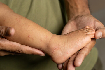 father holding the leg of a HFMD infected child, Care for Hand foot mouth disease , copy space on the right