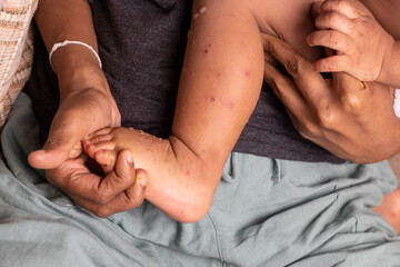 Close-up of a mother holding a leg of a child infected with hand-foot-mouth disease or HFMD originating from enterovirus or coxsackie virus