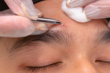 Closeup shot - removing a blackhead below the eyebrow with a pair of tweezers after using a...