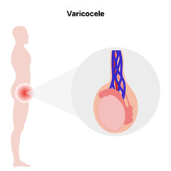 Varicocele problem