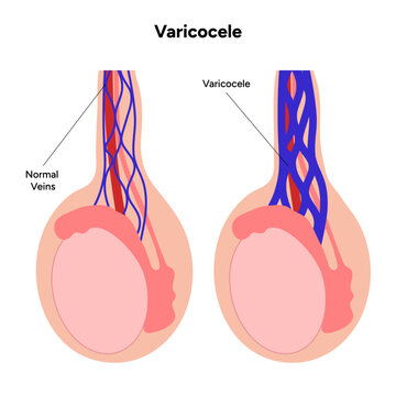 Varicocele disease 