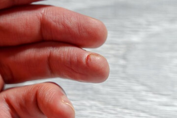 Painful wound on the finger from a deep cut