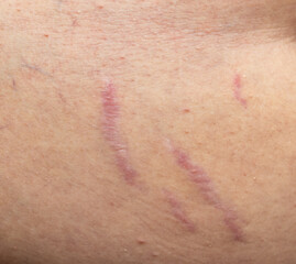 Fototapeta premium scars from stretch marks on the skin of the abdomen.