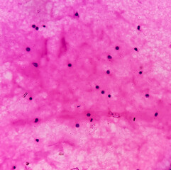 Scrotal hydrocele(FNA cytology): microscopic image shows lymphocytes and hostiocytes. background of fluidy material. no malignant cell present. scrotal swelling or testicular pain.