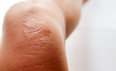 Naklejka premium Close-up of scars on knee skin imperfections or defects caused by an accident scar healthcare concept