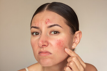 Young brunette Caucasian woman examines the pimples on her face. Girl is experiencing discomfort,...