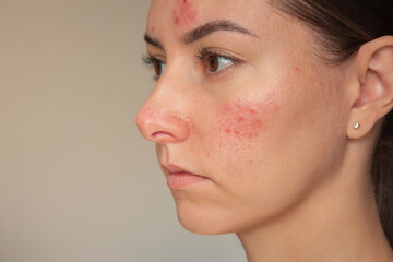 Close-up photo of young pretty Caucasian woman suffering from the skin chronic disease rosacea on...