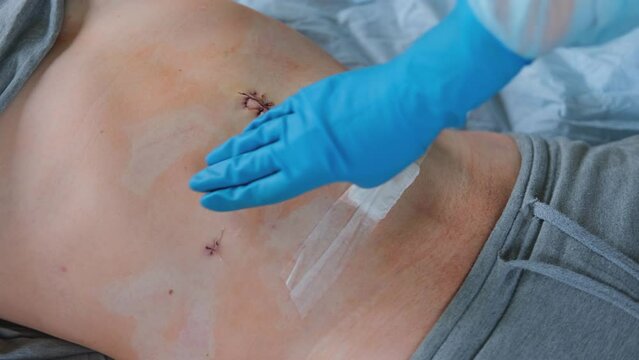 Hands of medic or nurse in blue gloves examining a fresh suture on a male stomach after laparoscopy surgical removal of appendicitis. Doctor examines of the patient. Man belly with medical stitches