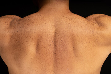 Close-up of the skin of a mature man with hyperpigmentation, on a black background, back, moles, freckles