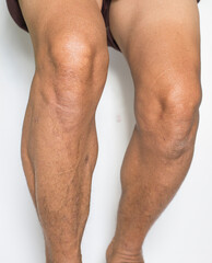 The leg and knee muscles of an old man who has arthritis problems and the bones and joints of the body on a white background