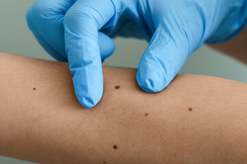 Dermatologist examining moles on woman's arm against green background, closeup