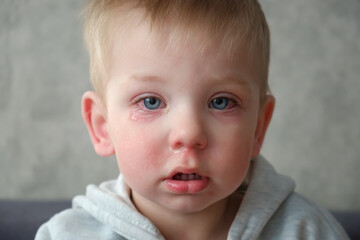 Red swollen eyes from conjunctivitis child, ill allergic eyes in babies. Close-up of a baby with conjunctivitis