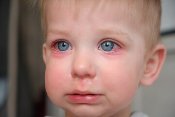 Red swollen eyes from conjunctivitis child, ill allergic eyes in babies. Close-up of a baby with conjunctivitis
