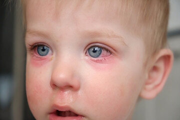 Red swollen eyes from conjunctivitis child, ill allergic eyes in babies. Close-up of a baby with conjunctivitis