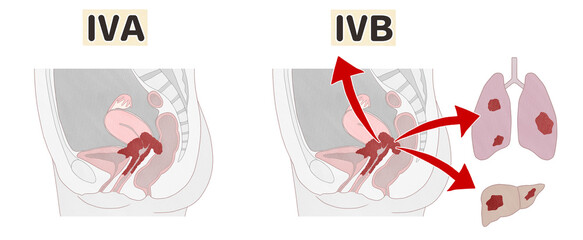 Stages of cervical cancer Stage 4 diagram PNG