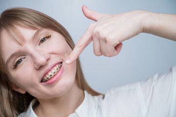 A beautiful red-haired girl smiles and points to the braces. Young woman corrects bite with orthodontic appliance