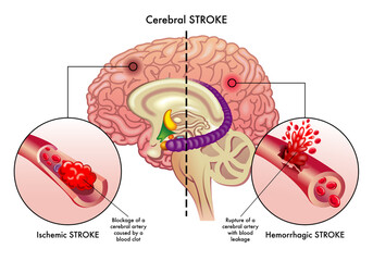 Medical illustration compares the causes of two types of cerebral stroke, an ischemic stroke, and a hemorrhagic stroke, which affect the cerebral arteries, with annotations