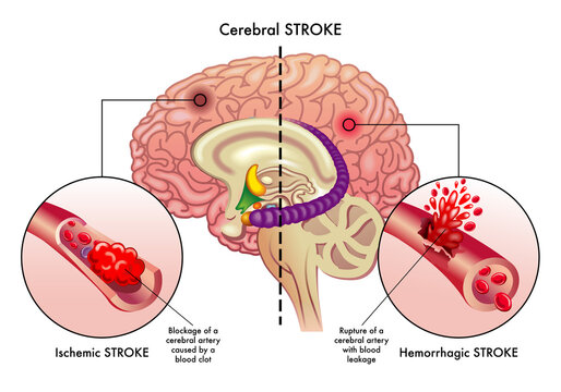 Medical illustration compares the causes of two types of cerebral stroke, an ischemic stroke, and a hemorrhagic stroke, which affect the cerebral arteries, with annotations