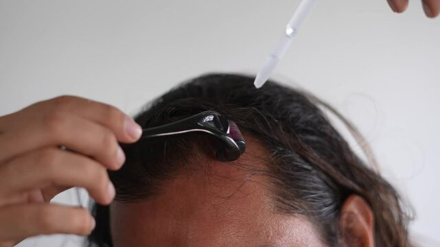 man using roller hair on his scalp to prevent baldness,  Hair thinning
